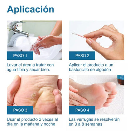 WART REMOVER | REMOVEDOR DE VERRUGAS Y LUNARES